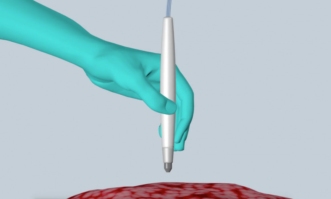 MasSpec Pen Can Differentiate Between Normal and Cancerous Cells