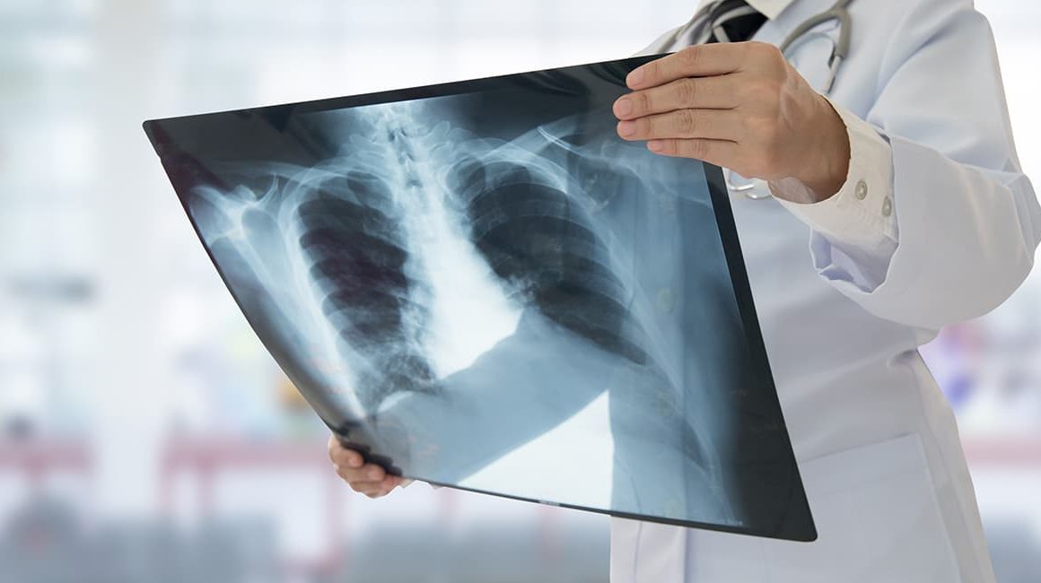 Doctor holding x-ray of chest area